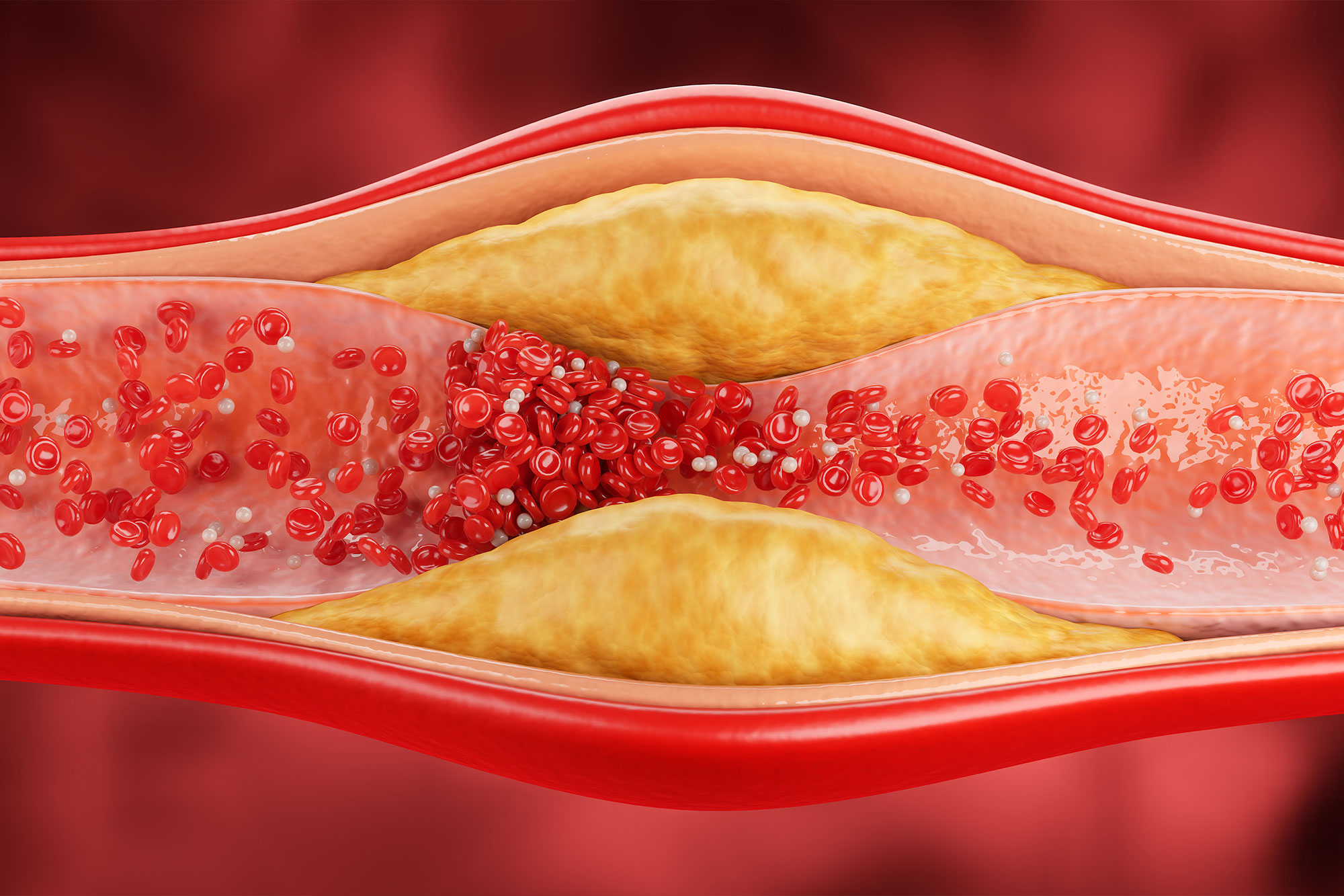 Grafische Darstellung einer Arterie mit gelblichen Ablagerungen im Inneren.